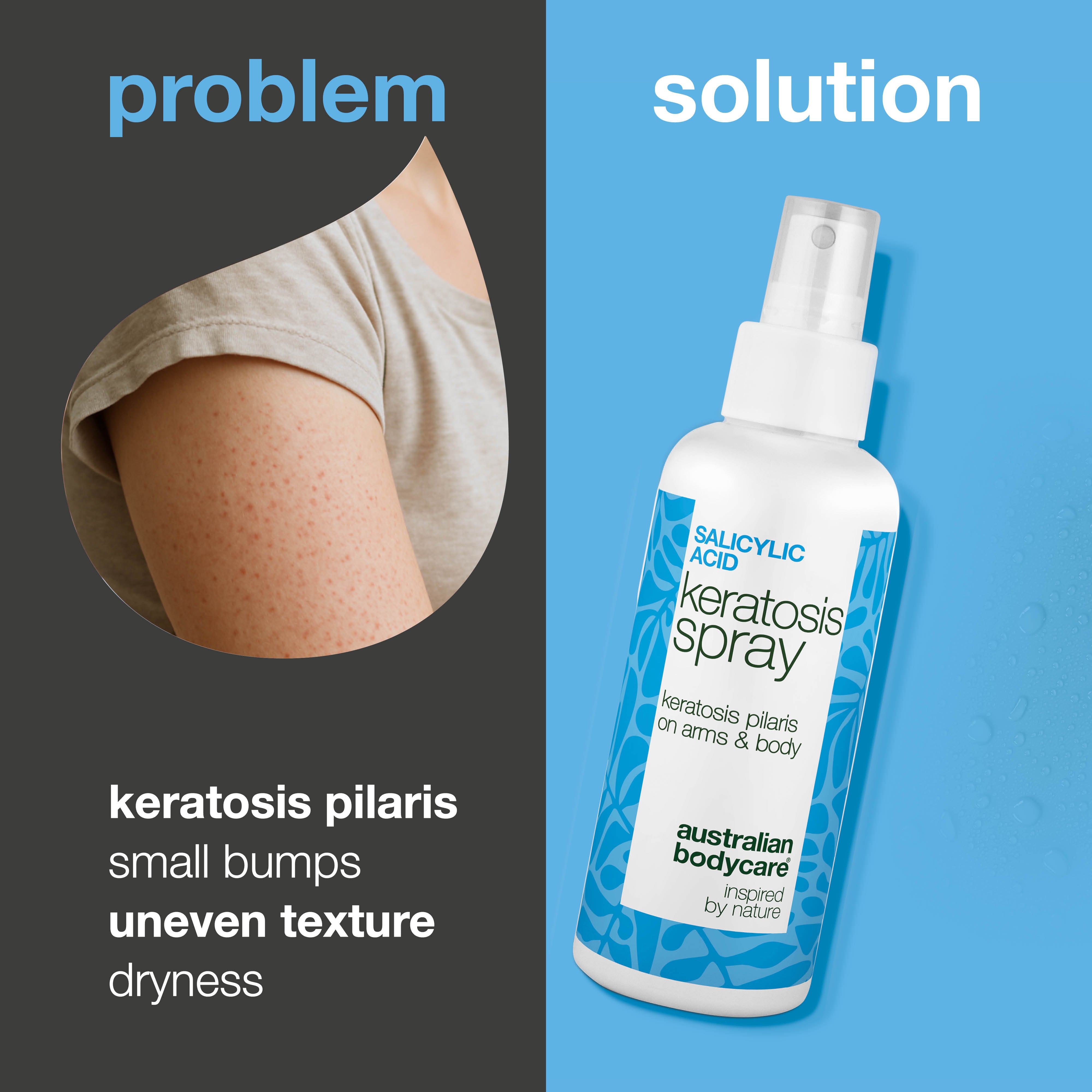 Keratosis Pilaris Spray for bumpy skin and chicken skin — Keratosis pilaris spray reduces rough, dry bumps on arms and thighs. Formulated with salicylic acid to exfoliate and soften skin.