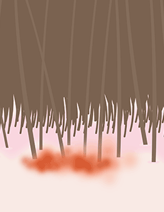 Folliculitis – infection in hair follicles