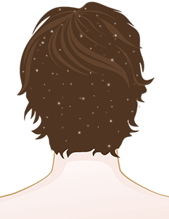 What causes dandruff?