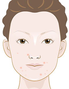 Blemished skin – How to reduce pimples and dry skin