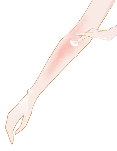 Heat rash – what is it, and how do you avoid it?