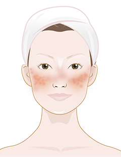 rosacea