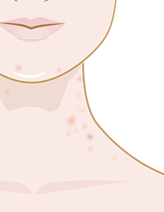 spots on neck