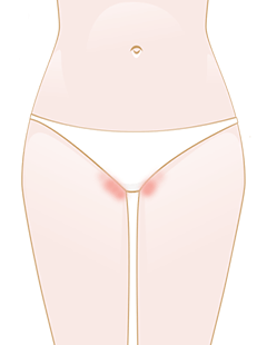 Vaginal thrush