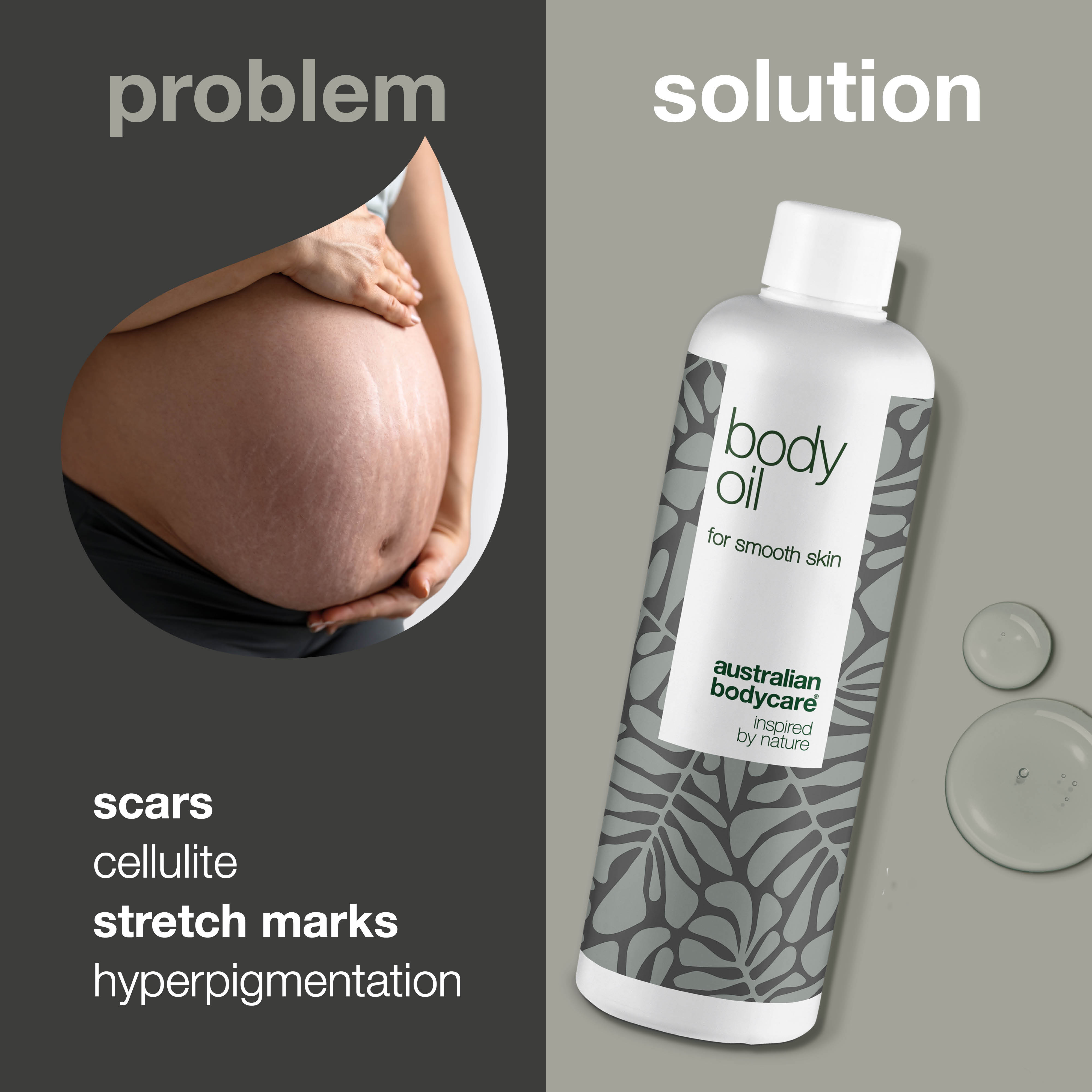 Body Oil – Reduces stretch marks, scars, and dark spots — Body Oil reduces stretch marks, scars, and dark spots. With almond oil, squalane, and vitamin E, it hydrates and smooths the skin.