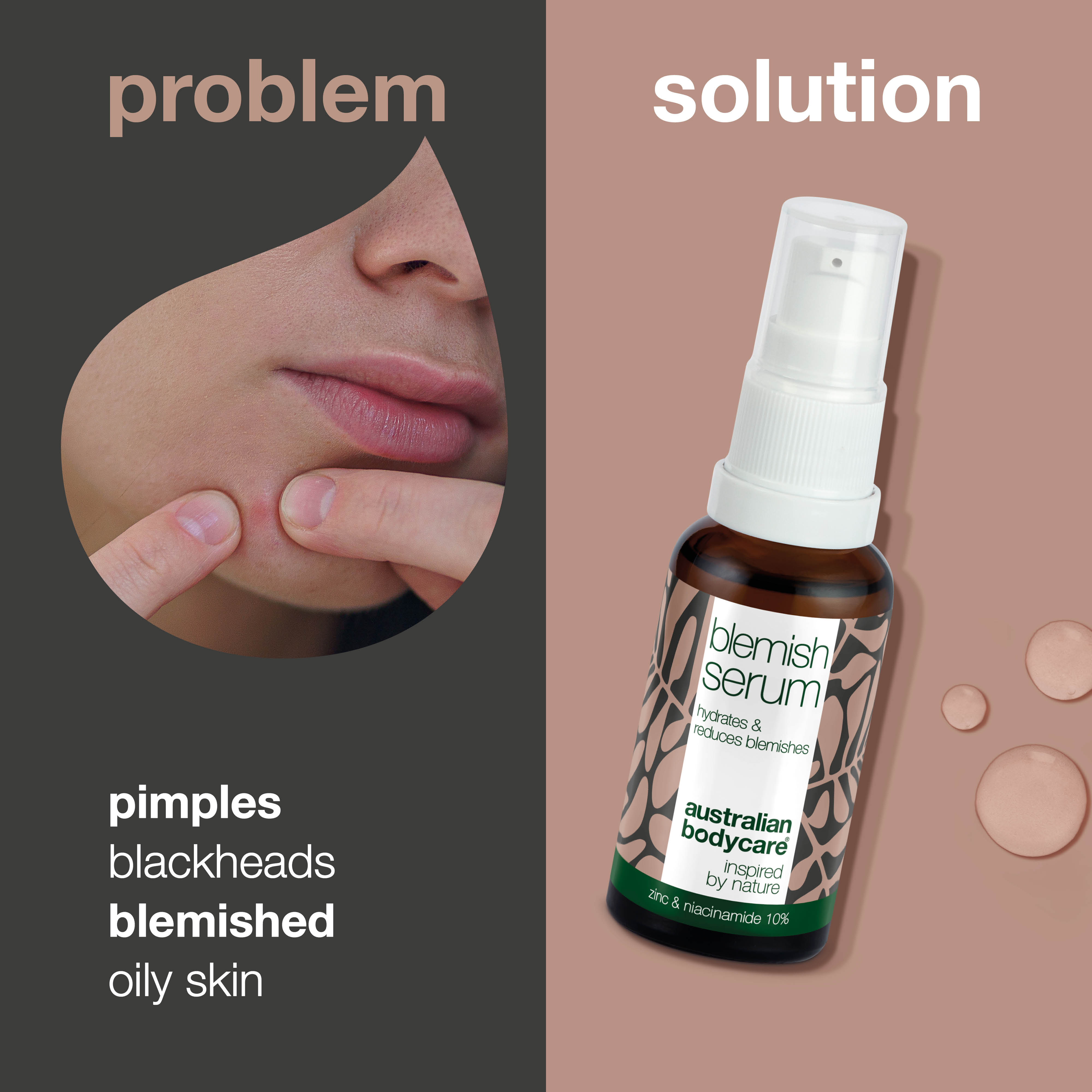 Niacinamide serum for spots and congested skin — With Niacinamide 10%, Zinc 1% and Tea Tree Oil for pimples, blackheads, and skin blemishes