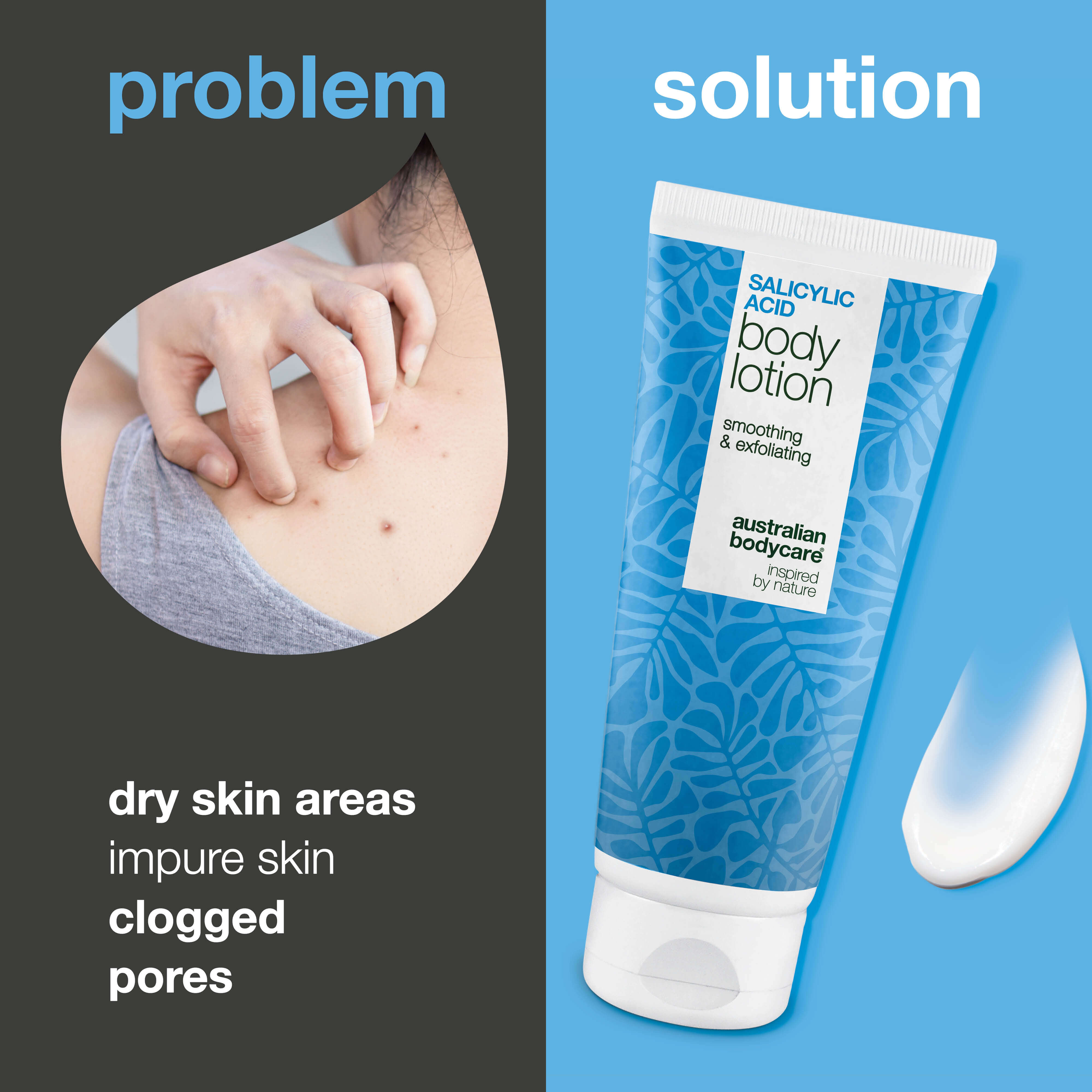 Body lotion with salicylic acid – for blemishes and dry skin — Body lotion with salicylic acid exfoliates, hydrates, and helps reduce blemishes, uneven texture, and dry skin. Perfect for daily use.