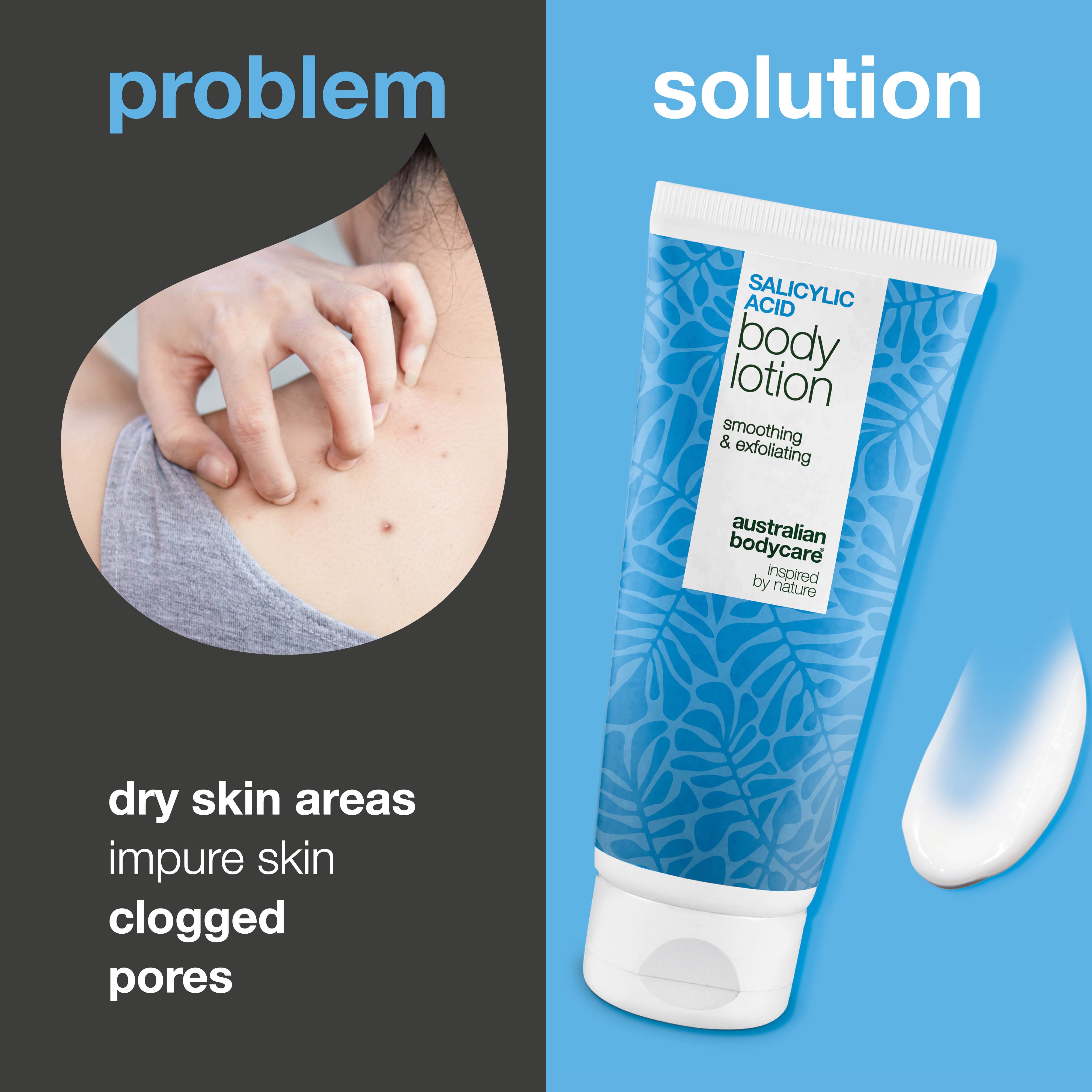 Body lotion with salicylic acid – for blemishes and dry skin — Body lotion with salicylic acid exfoliates, hydrates, and helps reduce blemishes, uneven texture, and dry skin. Perfect for daily use.