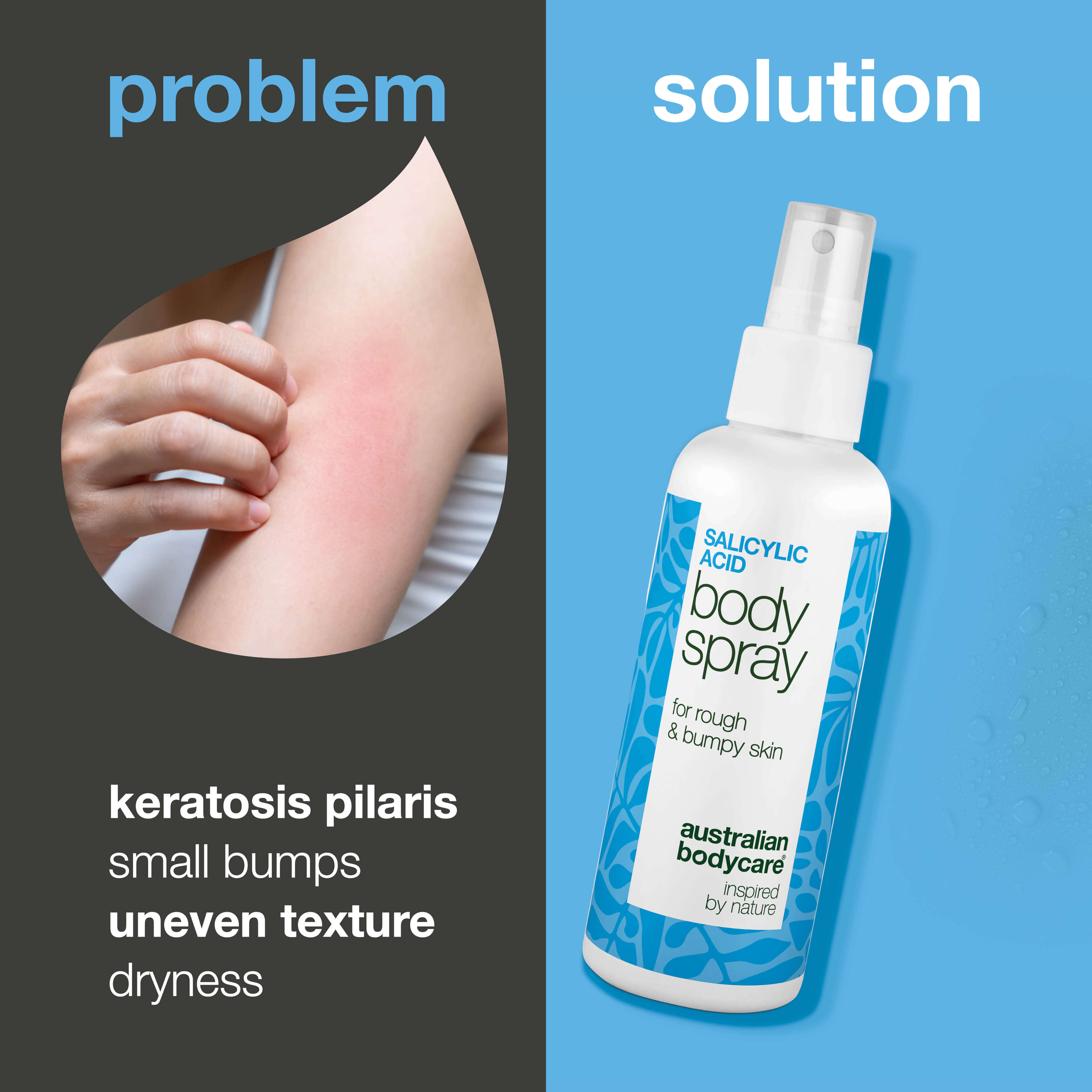 Keratosis Pilaris Spray for rough, dry skin and chicken skin. Contains salicylic acid, glycolic acid, glycerin and panthenol to smooth and hydrate.