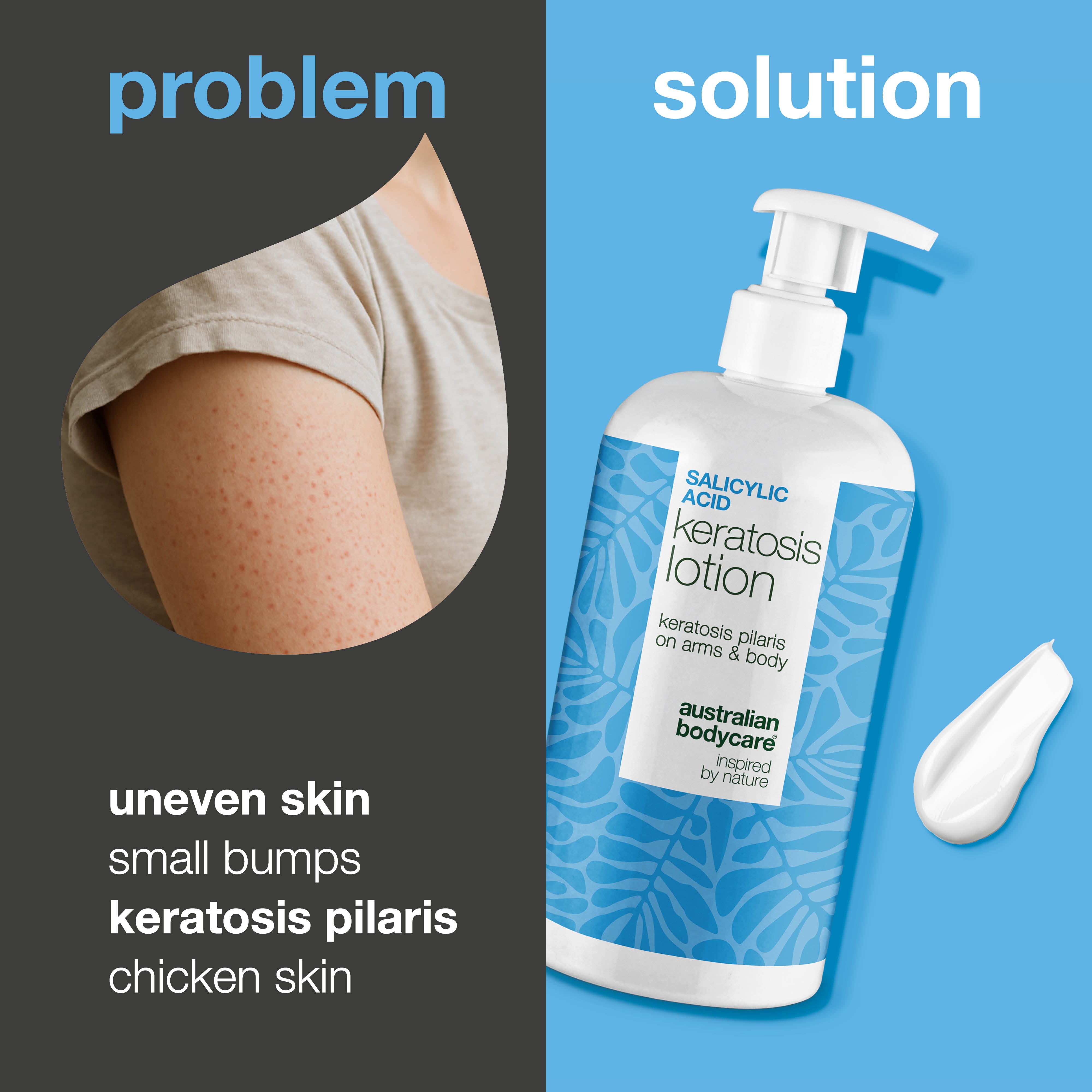 Body lotion for keratosis pilaris and rough, bumpy skin — Body lotion for keratosis pilaris and dryness. Smooths skin with salicylic acid, niacinamide, and zinc.