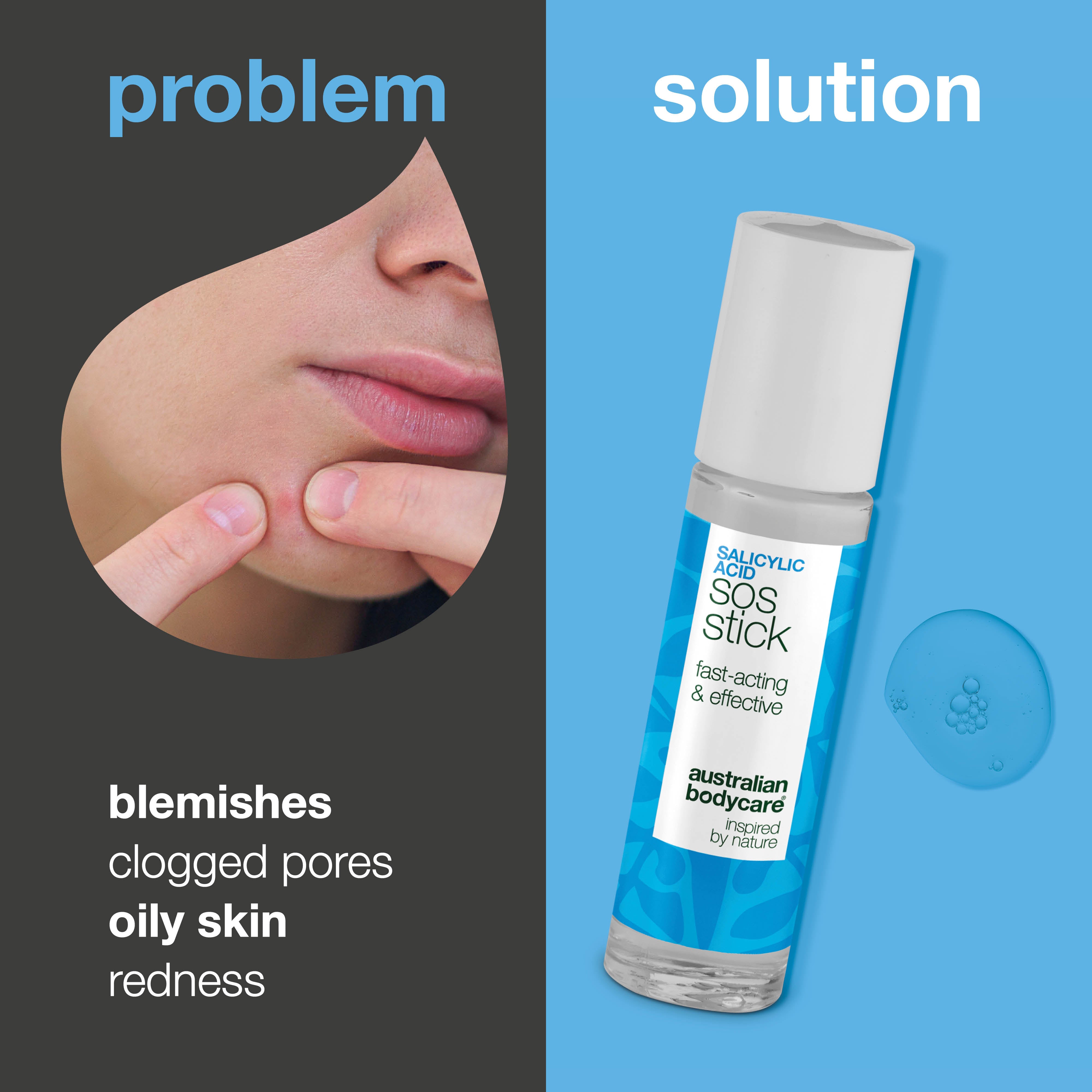 Salicylic Acid SOS Stick for breakouts and redness – unclogs pores and calms the skin fast