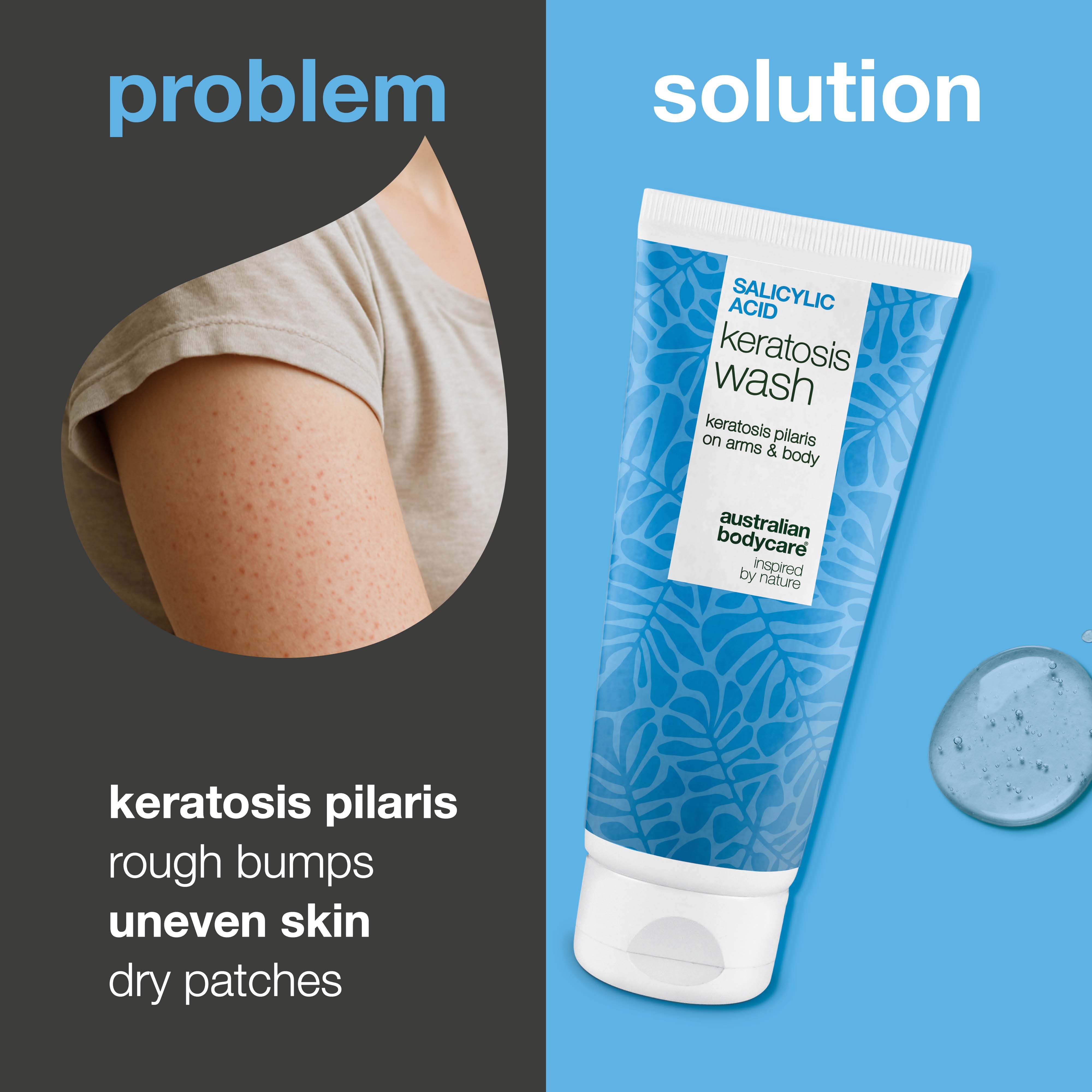 Keratosis Pilaris Body Wash for dry, bumpy skin and clogged pores. Features salicylic acid, niacinamide, and vitamin E to calm, exfoliate, and hydrate.