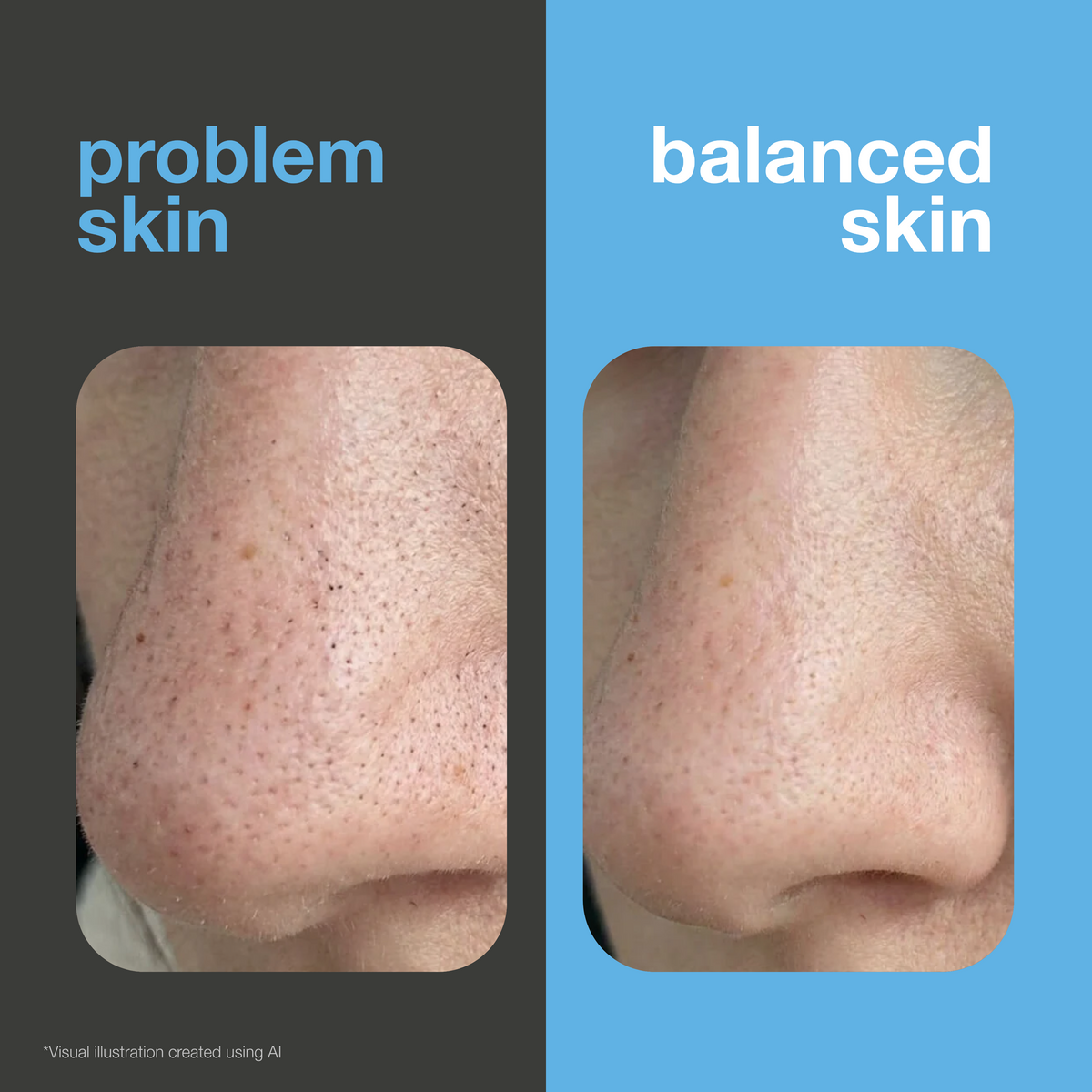 Before and after: a nose with visible blackheads and enlarged pores on the left, and the same nose with clean, smooth skin on the right. Visual illustration created with AI.