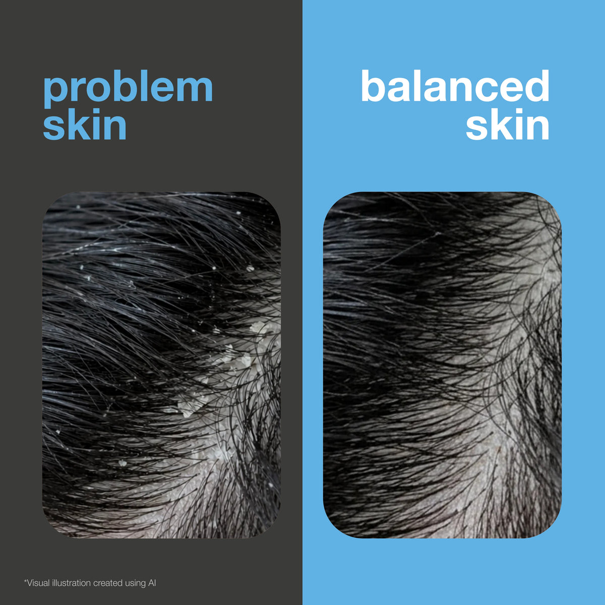 Before and after: a dark-haired scalp with visible white flakes on the left, and the same scalp free of dandruff on the right. Visual illustration created with AI.