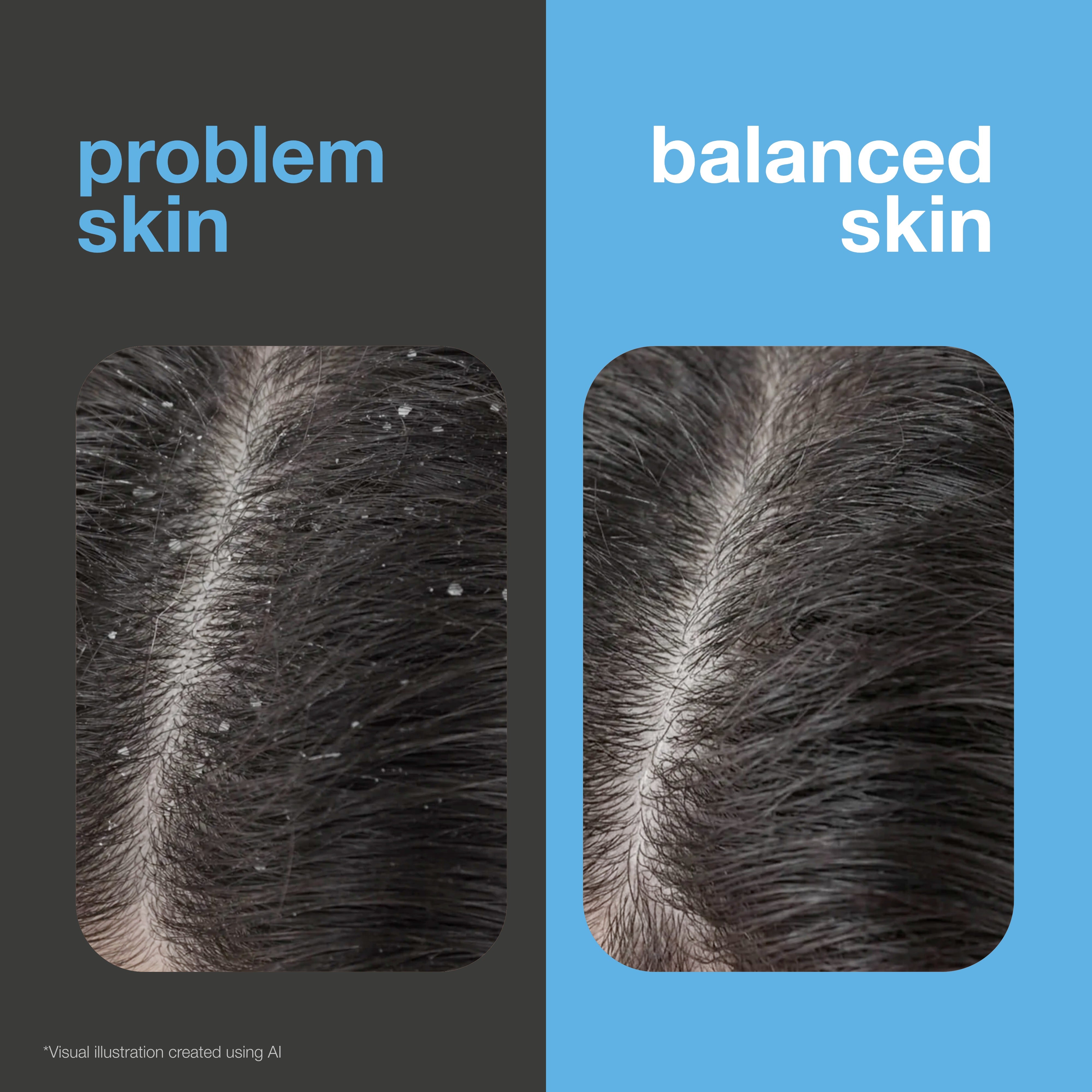 Before and after: scalp with visible flakes versus a flake-free, balanced scalp. Visual illustration.
