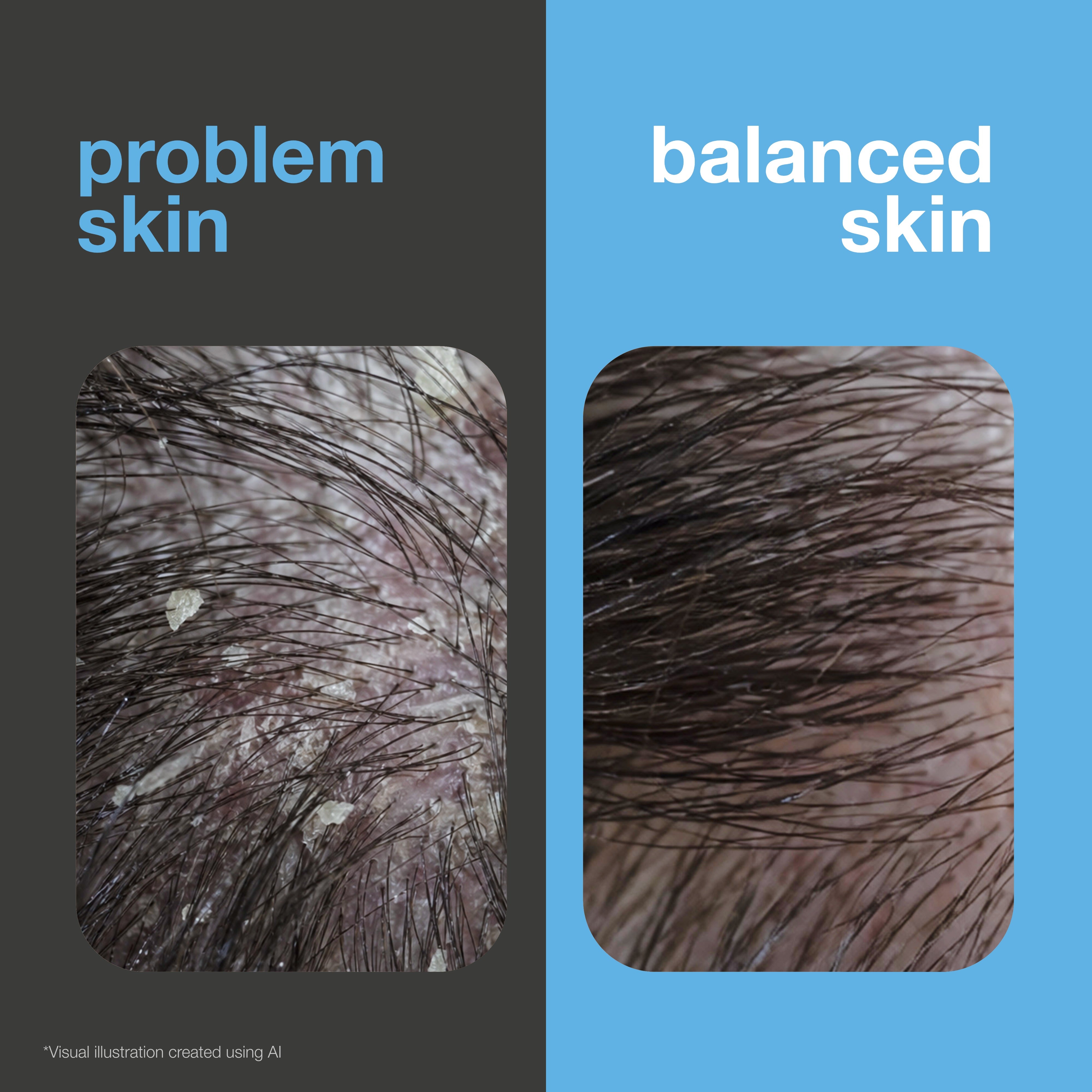 Before and after: scalp with visible flakes versus a flake-free, balanced scalp. Visual illustration.