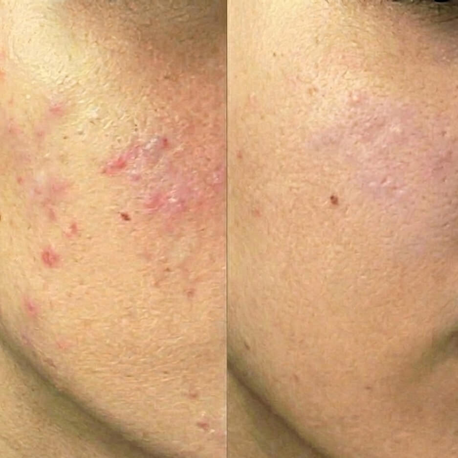 Before and after image from a customer showing reduction of redness and blemishes on the cheek after using SOS Stick.