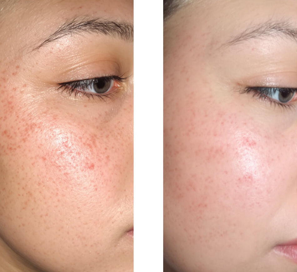 Before/after image of a customer using our 2% Salicylic Acid Face Serum, showing great improvement in the skin with fewer pimples and blemishes.