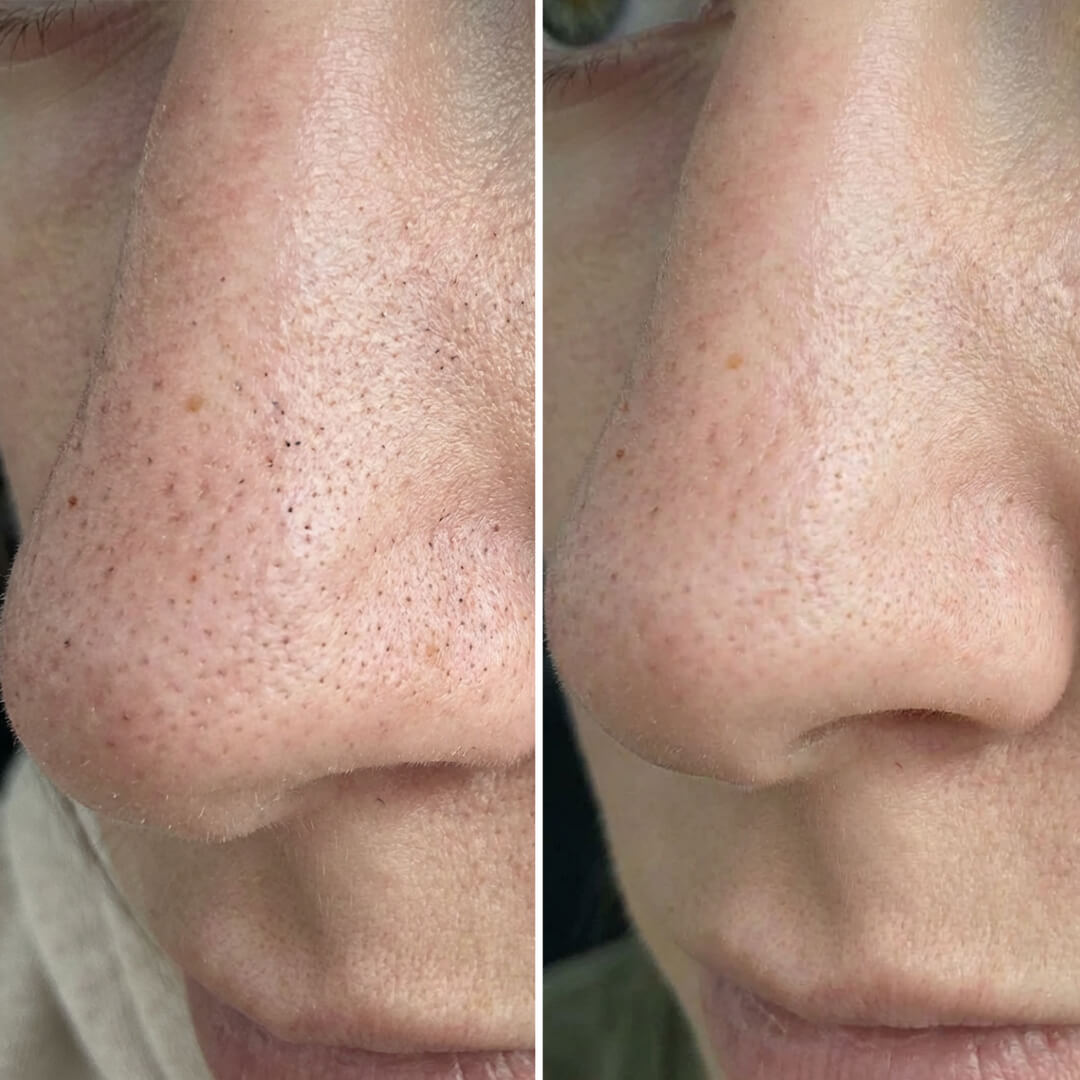 Kit for blackheads and clogged pores with salicylic acid – deep-cleansing routine for smooth, clear skin