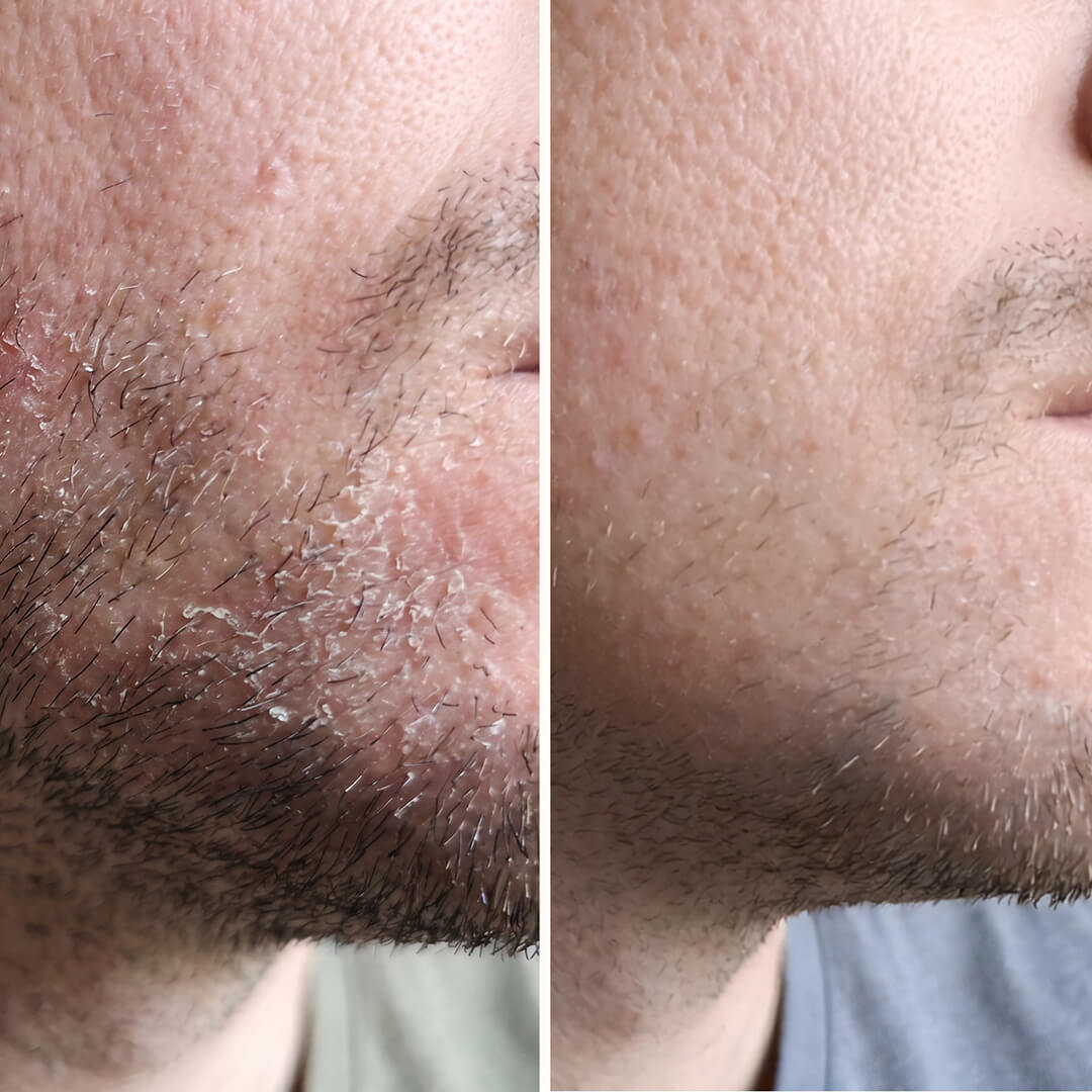 Salicylic Acid Serum – For Beard & Facial Dandruff — Effective serum for beard dandruff and seborrheic dermatitis. Salicylic Acid clears flakes and redness fast to restore skin balance.