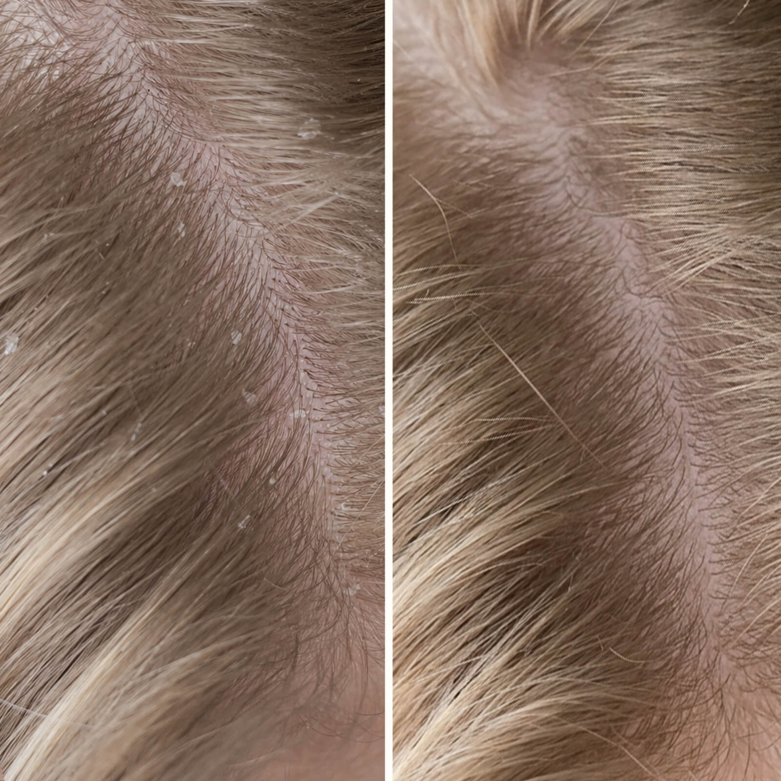 Salicylic Acid Shampoo for Dry & Itchy Scalp — Get rid of an itchy scalp and dandruff with this shampoo. Soothes dry skin and removes dead skin cells with Salicylic Acid.