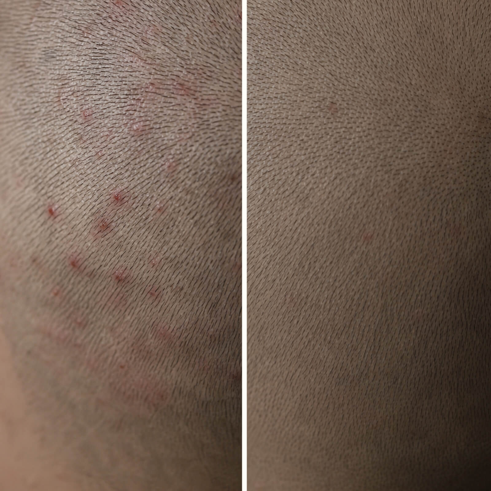 Salicylic Acid Gel for Pimples on Scalp & Itchy Bumps — How to get rid of pimples on your scalp? Use our Salicylic Acid Gel to exfoliate pores and soothe itchy, red, and painful spots instantly.