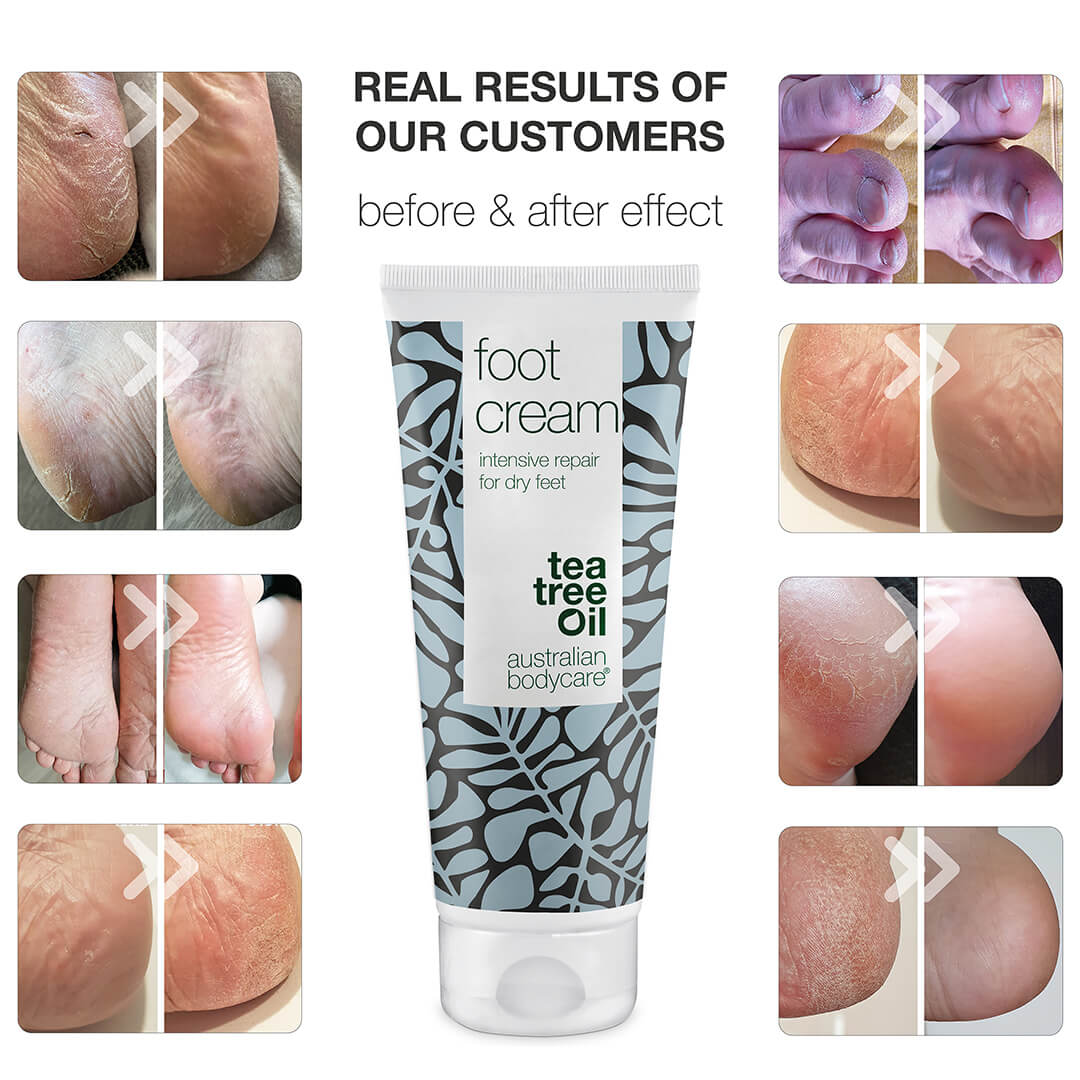 Foot Cream with 10% urea for dry feet - Nurturing foot cream for dry skin on feet with 100% natural Tea Tree Oil