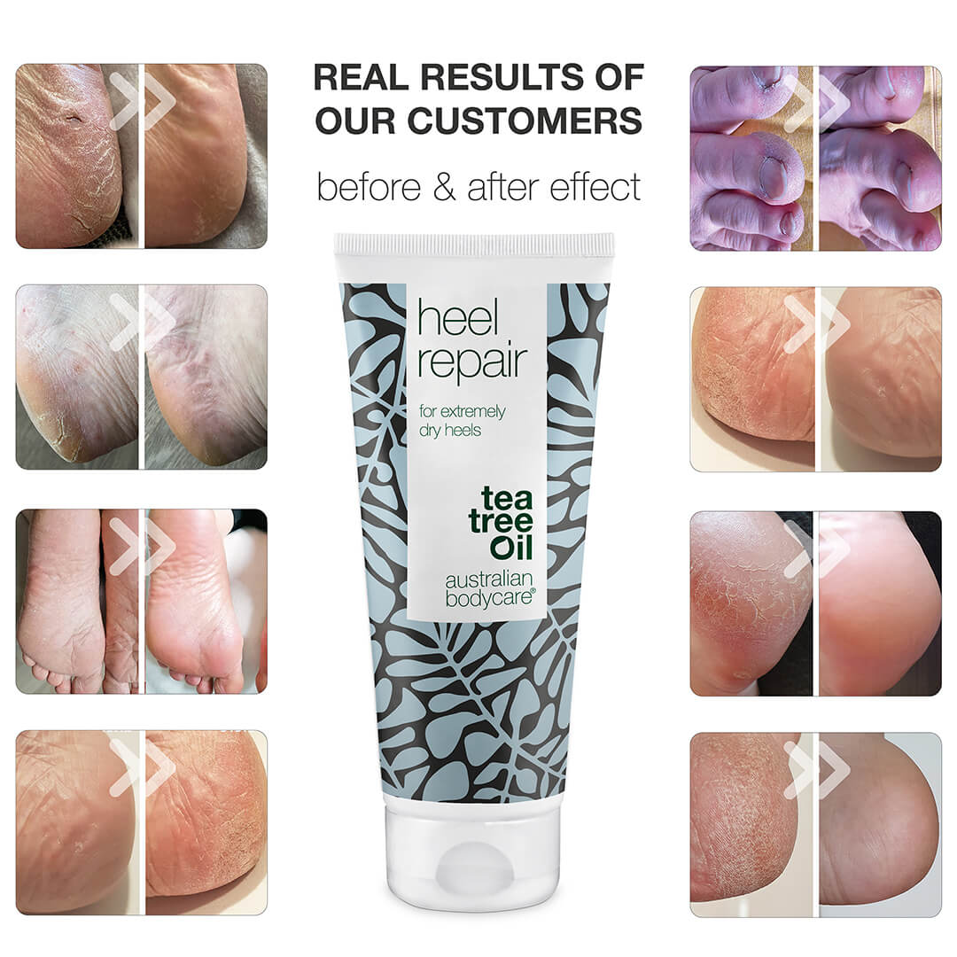 Heel Cream for Dry and Cracked Heels — Tackle cracked heels and dry feet with our heel repair. Contains 25% urea and natural 4-Terpineol, known from Tea Tree Oil.