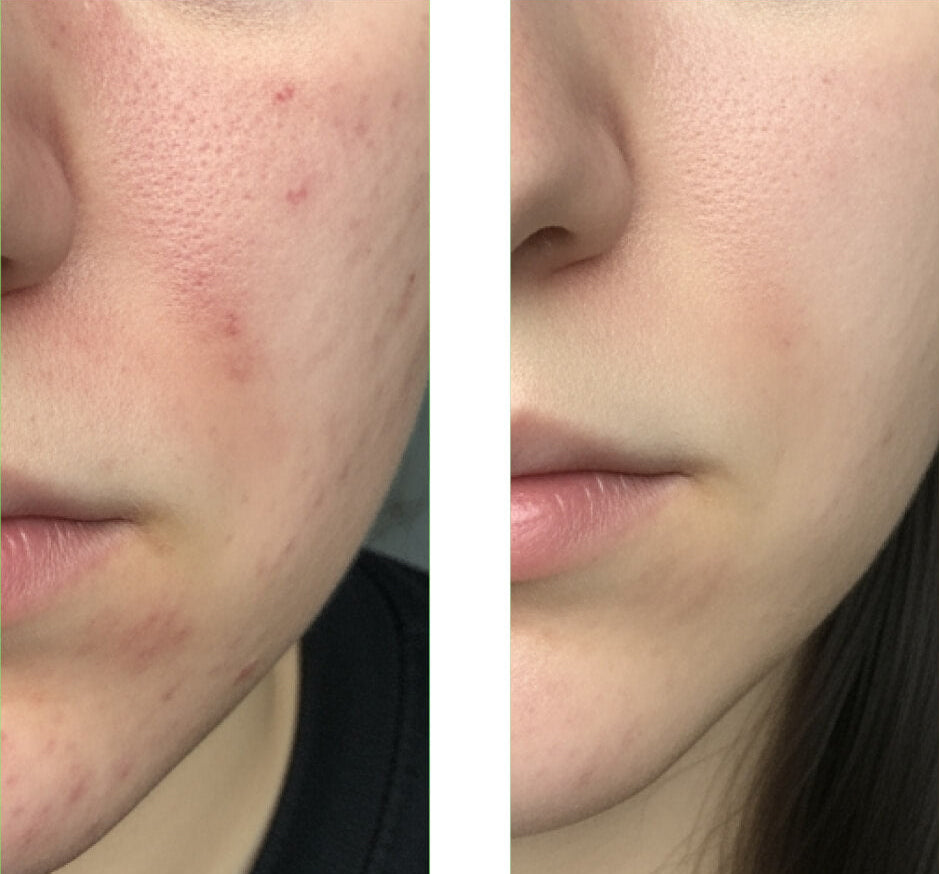 Before/after image of a customer using our Salicylic Acid Cleanser, showing great improvement in the skin with fewer pimples and blemishes.